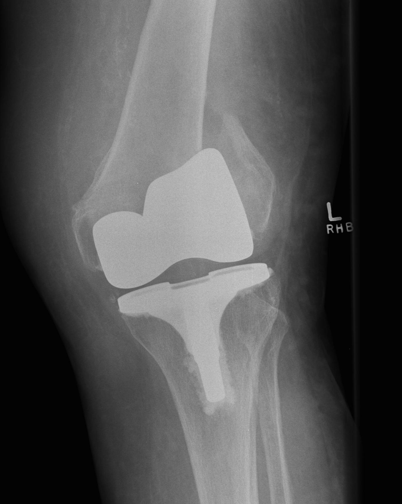 TKR Periprosthetic Fracture AP